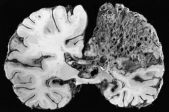 Importante malformation artério-veineuse dans la région du cerveau, le tissu a été majoritairement remplacé par le conglomérat vasculaire pathologique.
