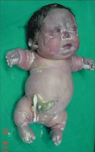 Description de l'image Achondrogenesis type I.jpg.