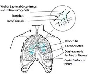 Description de l'image Acute-bronchitis.jpg.