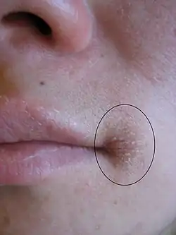 Image illustrative de l’article Perlèche