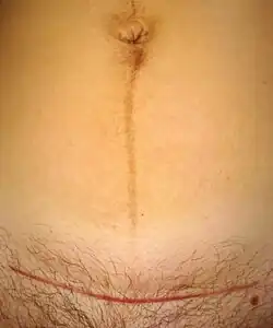 Cicatrice d'une césarienne (ligne horizontale rouge) et Linea nigra chez une femme de trente-et-un ans, sept semaines après l’accouchement.