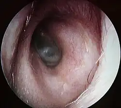 Conduit auditif externe gauche, au fond le tympan