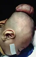 Encephalocèle sur la tête d'un enfant de deux ans.