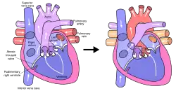 Schéma d'un cœur avant et après l'intervention de Fontan.