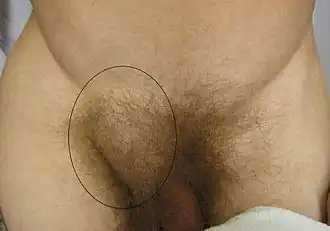 Description de l'image Hernia.JPG.