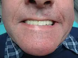 Bridge en place, la gencive n'est pas visible lors du sourire.