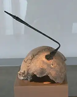 Crâne trépané (IIe&nbsp;siècle&nbsp;av. J.-C.) découvert à proximité de la porte Est de l'oppidum de Manching.