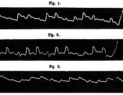 Pouls paradoxal de Kussmaul