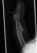 Radiographie montrant une fracture à l'insertion du tendon extenseur