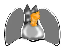 Dessin représentant un thymome stade III.