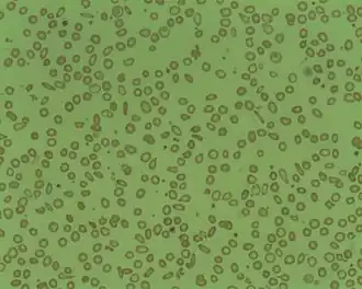 Description de l'image Microcytosis.jpg.