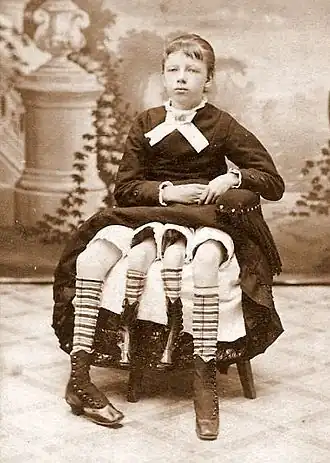 Myrtle Corbin (1868–1928) « La fille à quatre pattes du Texas ».