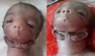 Description de l'image Otocephaly.png.