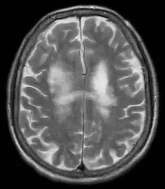 Description de l'image Progressive multifocal leukoencephalopathy 002.jpg.