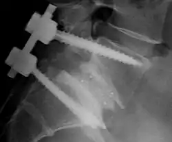 Description de l'image Roe LWS Spondylodese L5-S1 seitlich.jpg.