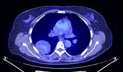 Coupe axiale de TEP thoracique.