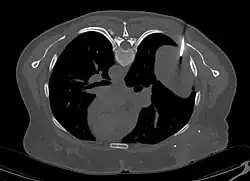 Coupe tomodensitométrique montrant une tumeur intrathoracique où est plantée une aiguille à biopsie.