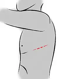 Thoracotomie latérale.