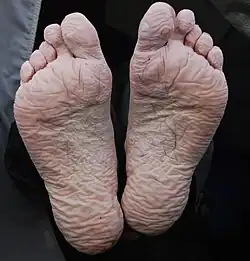 Peau de la plante des pieds hyperhydratée par un séjour dans l'eau.
