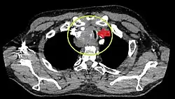 Coupe en noir et blanc montrant 2 anneaux jointifs, avec une masse rouge et un cercle jaune à la jointure.