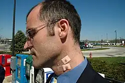 Homme présentant la trace d'une morsure par canines au cou.