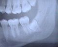 Radiographie de dents saines (prémolaires, molaires, dent de sagesse incluse) et cariées (2e&nbsp;prémolaire supérieure et 1re&nbsp;molaire supérieure).
