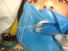 Photographie d'une femme ayant la bouche recouverte d'une plaquette de latex bleue.