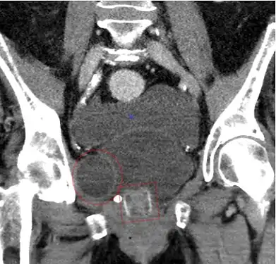 CT Scan (reconstruction coronal) montrant un AMS 800 chez une femme