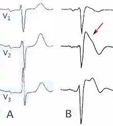 Comparaisons d'electrocardiogrammes (dérivations précordiales) chez