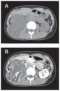 Comparaison côte à côte de deux coupes scanner.