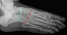 Radiographie du pied: articulation de Chopart (talo-navicualire et calcanéo-cuboïdienne) en vert et articulations de Lisfranc (tarso-métatarsiennes) en rouge.