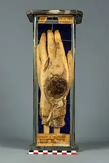 Main gauche atteinte de radiodermite chronique hyperplasique.