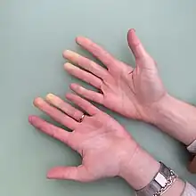 Photo de mains d’une femme dont la dernière phalange de chaque doigt est d’une couleur jaunâtre