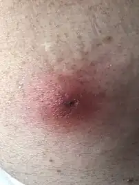 Myase au stade furonculeux.