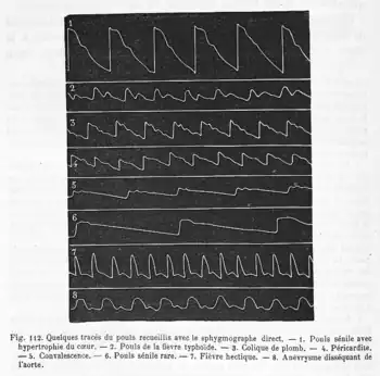 Fig. 112. Quelques tracés du pouls recueillis avec le sphygmographe direct de Marey. - 1. Pouls sénile avec hypertrophie du cœur. - 2. Pouls de la fièvre typhoïde. - 3. Colique de plomb. - 4. Péricardite. - 5. Convalescence. - 6. Pouls sénile rare. - 7. Fièvre hectique. - 8. Anévrysme disséquant de l'aorte.