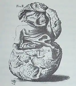 Représentation d'un lithopédion au XVIIIe&nbsp;siècle.