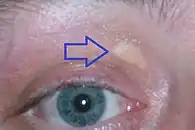 Image illustrative de l’article Xanthelasma